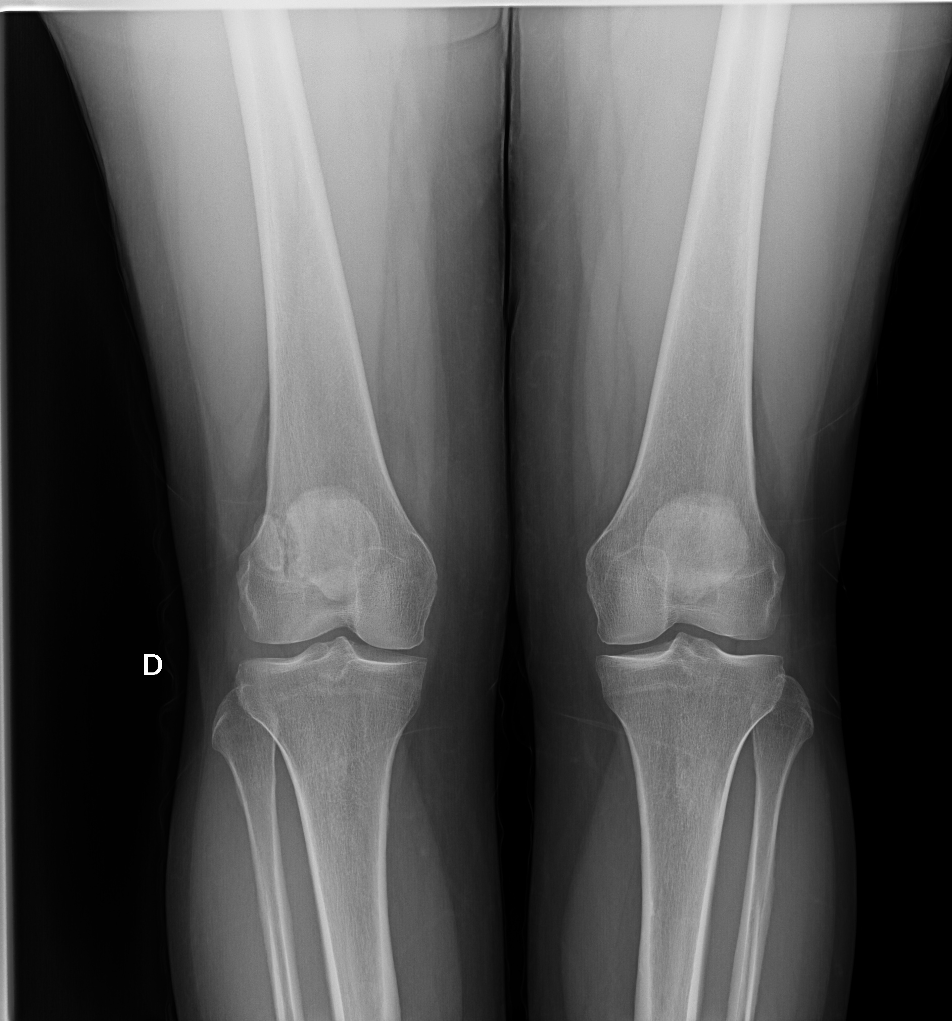 Radiografia de rodilla