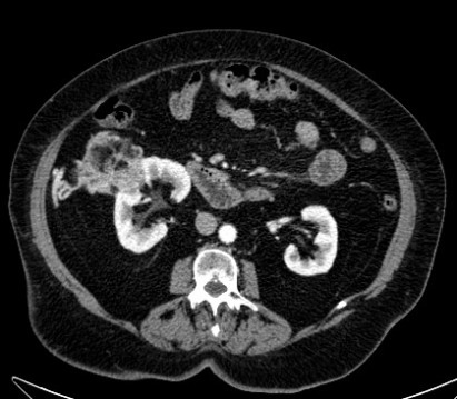 Se obseva una masa bien vascularizada en región intermedia del riñón que realza en fase corticomedular y con grasa macroscópica.