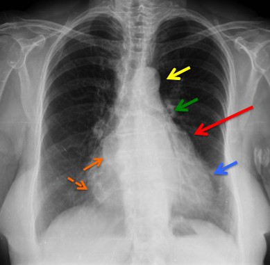 Flecha roja: signo del 3º mogol por crecimiento de la aurícula izquierda. Signo del doble contorno: La AI aumentada de tamaño produce un segundo contorno que normalmente no debería figurar (flecha naranja contínua). Flecha amarilla: cayado aórtico. Flecha verde: arteria pulmonar. Flecha azul: ventrículo izquierdo.