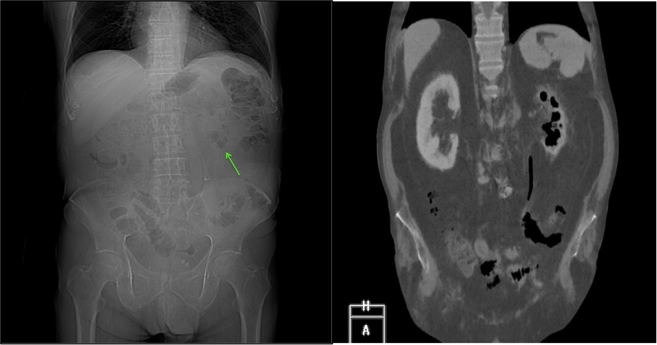 IZQ: Scout de TC abdominal donde se observa una burbuja aérea proyectada sobre el polo inferior del riñón izquierdo. Derecha: Reconstrucción coronal de TC abdominal donde se confirma el hallazgo en el contexto de una pielonefritis enfisematosa.
