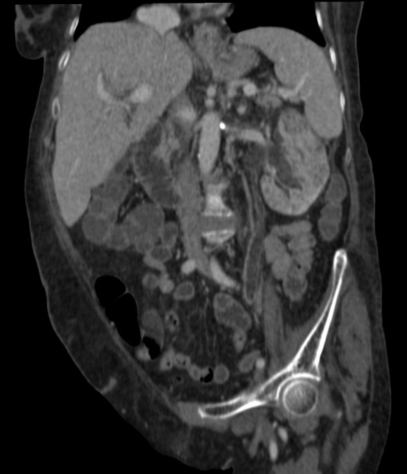 En la reconstrucción coronal se observa el riñón con multiples zonas de nefritis dispersas en el parénquima y diltación del sistema pielocalicial, mostrándo además el ureter dilatado hasta la vejiga y con realce mural.