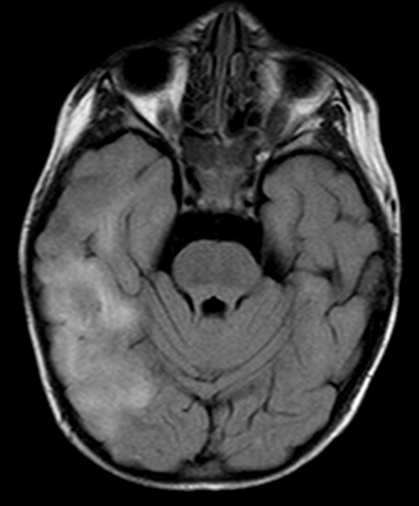 Encefalomielitis diseminada aguda (EMDA).